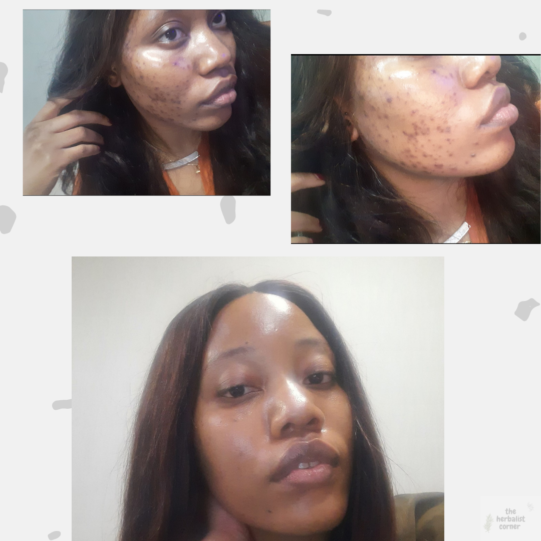 Treating Hyperpigmentation for Black Skin  