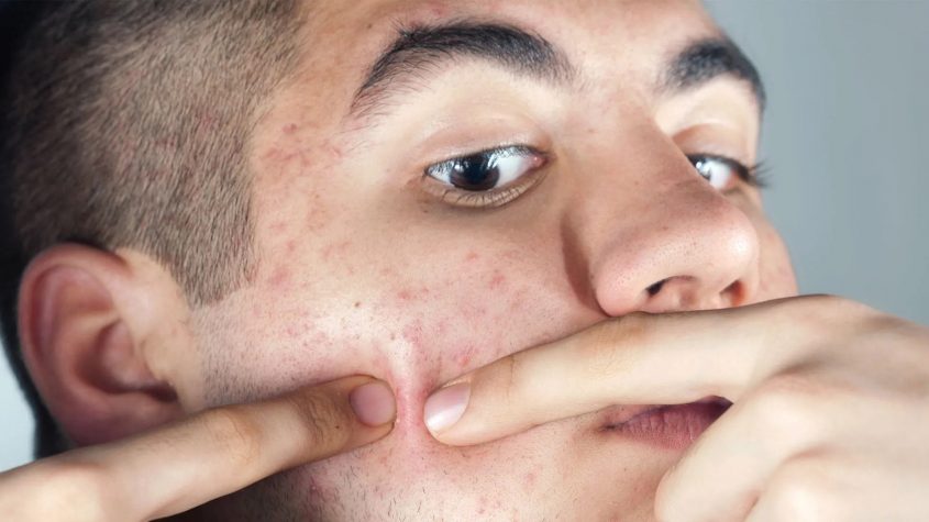 Most Effective Treatments for Men With Acne